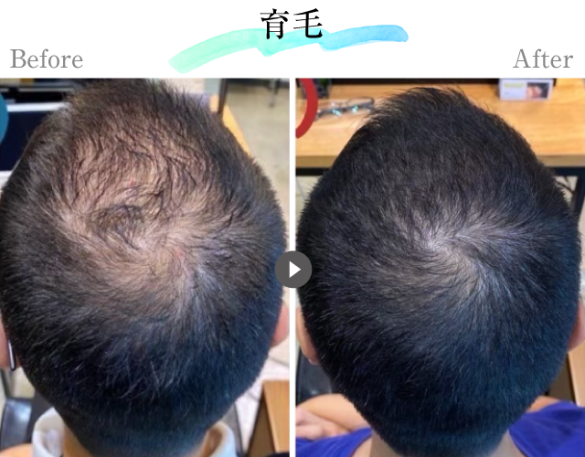 育毛