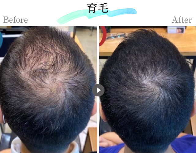育毛